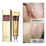 2017 NA Acne Scar Cream Ginseng Essence Anti Acne Remover Cream Face Care Makeup Spots Stretch Marks Remove Scar Product WH998