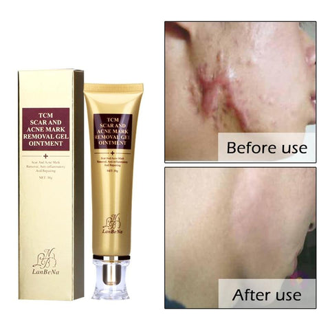 2018 LANBENA Acne Scar Cream Ginseng Essence Anti Acne Remover Cream Face Care Makeup Spots Stretch Marks Remove Scar Product