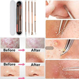 Stainless Steel Blackhead Remover Acne Needle Tweezers Blackhead Extractor for Pimple Blemish Comedone Acne Spots Remover Kit